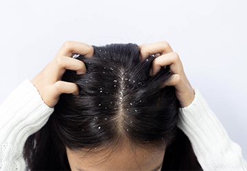 3 Effective Ways to Fight Dandruff