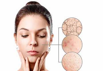 Combating Acne Strategies for Prevention and Effective Treatment